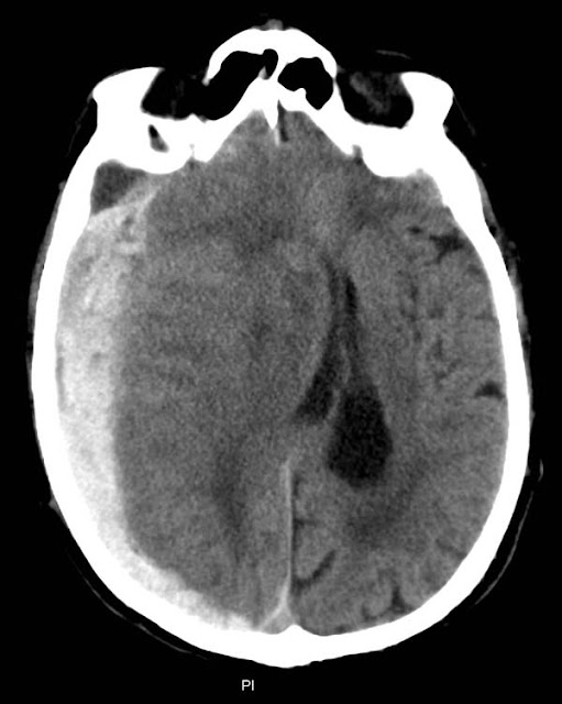 Brain Herniation2