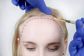 Female-hair-transplant-last-remedy