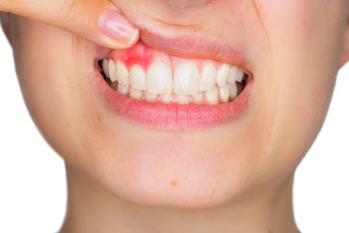 Cách trị sưng nướu răng-1