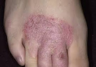 Bagaimana Cara Mengobati gatal eksim Kering, mengatasi gatal pada eksim, Ramuan Obat Eksim Kering, Mengobati gatal eksim Dengan Jelly Gamat, Cara Mengobati Eksim Pada Telapak Kaki, Eksim Basah (Dermatitis Numularis), Obat Tradisional Untuk gatal eksim Pada Kaki, Cara Mencegah Penyakit Kulit Eksim, Salep Untuk Mengobati Eksim Basah, Gatal Di Selangkangan Karena Apa, Nama Obat gatal eksim Kering Di Apotik, Gatal Di Daerah Rambut Kemaluan, Eksim Kering Obatnya Apa, gatal eksim Basah Saat Hamil, Gatal Di Kemaluan Apa Obatnya, gatal eksim Kering Sembuh, obat generik untuk gatal eksim, Gatal Di Kemaluan Seperti Ketombe, Penyakit gatal eksim Seborrheic, Obat Eksim Numular, ciri gatal eksim, gatal eksim di selangkangan, Apakah gatal eksim Basah Bisa Sembuh, Eksim Atau Dermatitis Adalah, Obat gatal eksim Kering Yang Menahun, Obat Apotik Untuk Penyakit Eksim Kering, Obat Minum Untuk Penyakit gatal eksim, Salep Penyakit gatal eksim Basah 