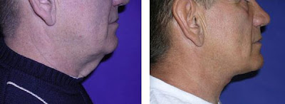 facelift treatments before and after