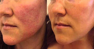 Rosacea Natural Treatment