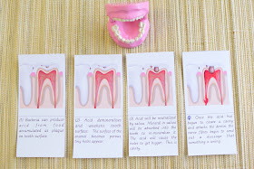 Dental Unit: What is a Cavity?