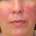 cara mengatasi iritasi wajah akibat pemakaian cream