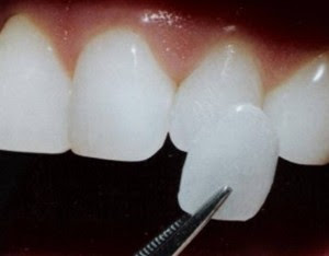 Tìm hiểu giá bọc răng sứ nguyên hàm
