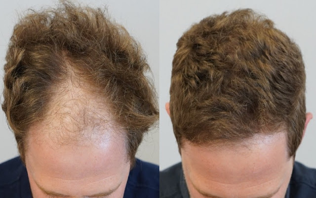 Uomo di 35 anni prima e dopo il trapianto di capelli con il metodo FUE Zaffiro