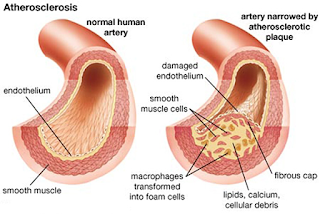 Atherosklerosis - penyempitan arteri oleh plak