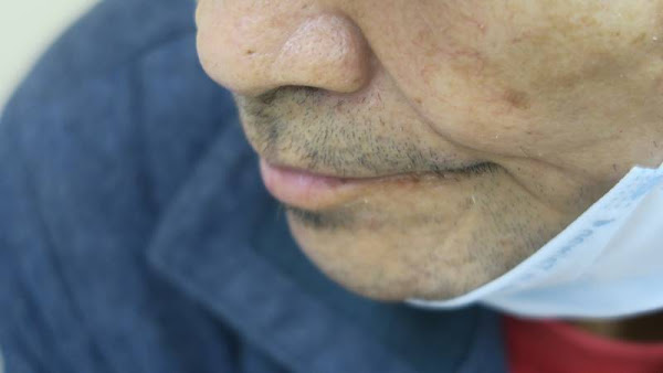 彰化男流鼻水大舌頭　竟是口腔癌三期腫瘤躥上鼻竇