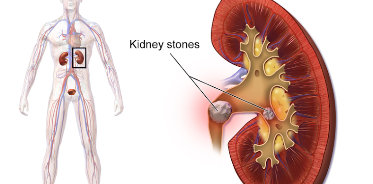 Cara Mengobati Batu Ginjal yang Berbahaya untuk Kesehatan kita