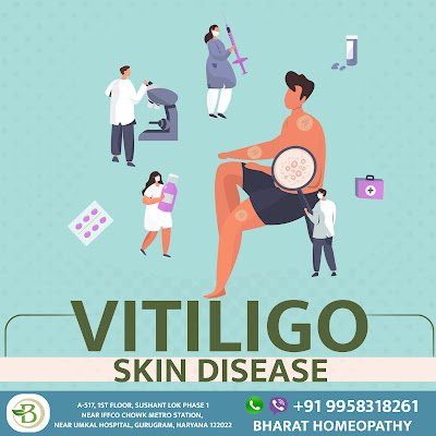 Vitiligo treatment by Homeopathy
