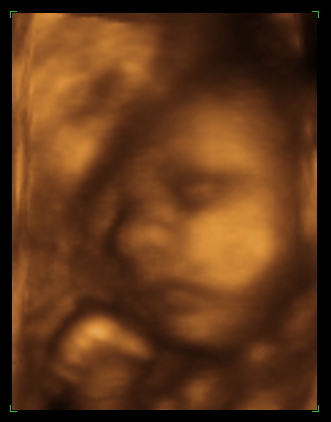 3d Ultrasound Pictures6