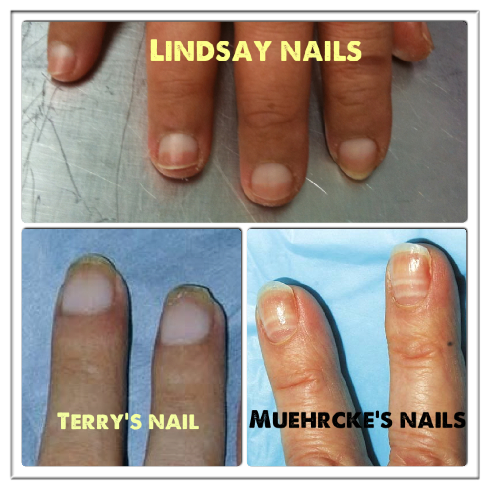 Terry's Nails: Pictures, Causes, Treatment, Vs. Lindsay's Nails