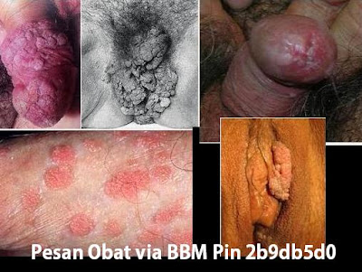 Obat Kutil Kelamin Selain Imiquimod