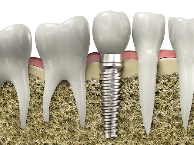 Osseointegration Implants Market