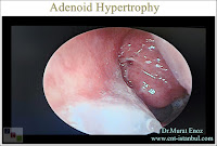 Adenoid Hypertrophy