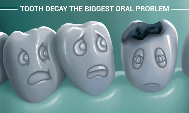 Tooth Decay-Solving the Biggest Oral Problem