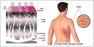 https://blogger.googleusercontent.com/img/b/R29vZ2xl/AVvXsEjD06CPw7PYyNHvPSodjpf7W5le803ZSXf57-tnlPJ-V45I8T3uVDFfUEroh4wO8AdmtC_4md1n3s3QtLPiuDM7pI0QQedpujxRe28jOoh03EnhxP_733thH82iBlAqrWtePfSh85fO_dY/s1600/herpes+di+tubuh.jpg