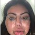 Surgery gone wrong! Instagram model suffers face swell after another botched plastic surgery in Brazil (Photos)