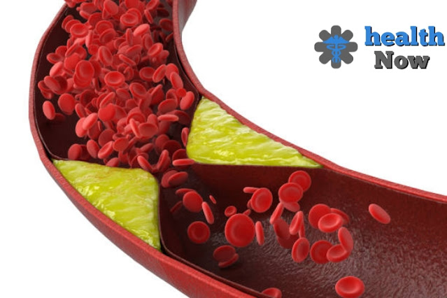 Atherosclerosis disease: symptoms and complications, diagnosis and treatment of the disease.