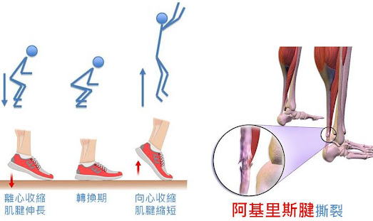 #阿基里斯腱 #跟腱 #阿基里斯腱太緊 ##阿基里斯腱病變 #阿基里斯腱斷裂 #預防 #後腳筋痛 #阿基里斯腱 PRP