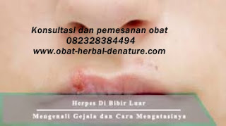 obat herpes kelamin,obat herpes zoster,obat cacar dompo,obat cacar air,obat herpes kemaluan,obat herpes tangan,obat herpes bibir,obat herpes badan