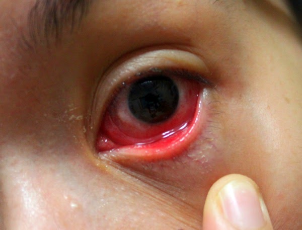 Ubat Titis Untuk Mata Merah - Contoh Diam