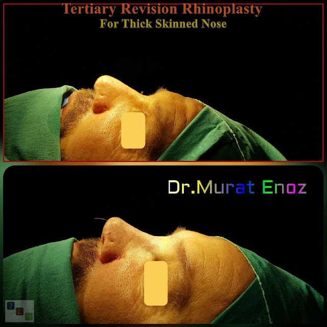 revision rhinoplasty, tertriary rhinoplasty for men istanbul, 3rd nose job, 3rd nose aesthetic surgery, micromotor assisted revision rhinoplasty, micro-motor assisted revision nose asthetic surgery