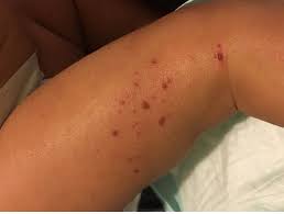 THE DEFINITE NATURAL TREATMENT OF ECZEMA OR CONTACT DERMATITIS