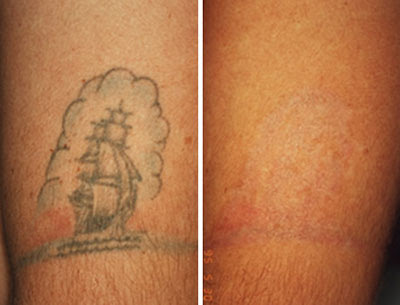 Many people discover Laser Tattoo Removal remedy gives the very best results