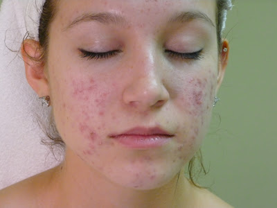 Treat acne when its origin is hormonal