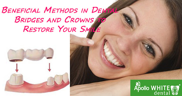  Beneficial Methods in Dental Bridges and Crowns to Restore Your Smile