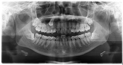 Răng khôn mọc ngầm trong xương có nguy hiểm không