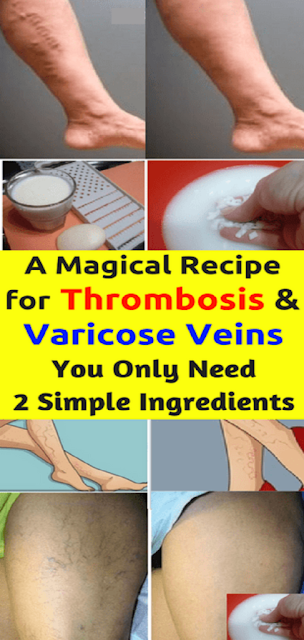 Magical Recipe For Varicose Veins And Thrombosis With Only 2 Simple Ingredients