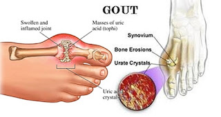 Obat Paling Ampuh Menyembuhkan Asam Urat, Mengobati Asam Urat Dengan Bahan Alami, Ciri Asam Urat Akut, Obat Alami Asam Urat Dan Pantangan Nya, Penyebab Asam Urat Di Usia Dini, Menu Rendah Asam Urat, Asam Urat Genetik, Obat Herbal Alami Mengatasi Asam Urat, Gimana Cara Mengatasi Asam Urat, Gejala Asam Urat Di Leher, Cara Buat Obat Alami Asam Urat, Asam Urat Penyebab Makanan, Obat Asam Urat Alami Apa Ya, Asam Urat Kopi, Cara Mengobati Asam Urat Herbal, Asam Urat Sebaiknya Makan, Asam Urat Makan Tahu Tempe, Obat Asam Urat Super, Apakah Asam Urat Boleh Minum Es, Batas Normal Asam Urat Untuk Laki Laki, Buah Yang Baik Untuk Asam Urat Dan Kolesterol, Apa Itu Asam Urat Dan Penyebabnya, Obat Herbal Atau Alami Untuk Asam Urat, Cari Obat Penyakit Asam Urat, Cara Menurunkan Trigliserida Dan Asam Urat, Obat Asam Urat Dari Makanan, Obat Asam Urat Yg Bengkak, Pengobatan Alami Asam Urat Dan Kolesterol, Kadar Asam Urat Normal Menurut Who, Manfaat Daun Binahong Untuk Obat Asam Urat 