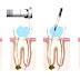 Endodontic therapy