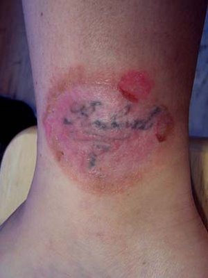 Methods for tattoo removal today include dermabrasion, surgical excision,