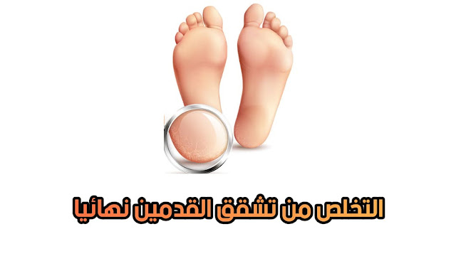 التخلص من تشقق القدمين نهائيا