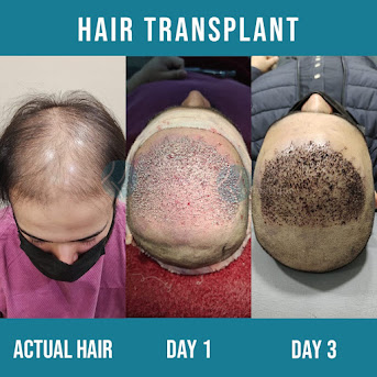 best hair transplant in Lahore, Best hair transplant Surgeon in Lahore