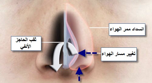 اضطراب حركة الهواء نتيجة ثقب الحاجز الأنفي