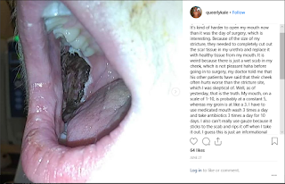 Scab in mouth and tongue