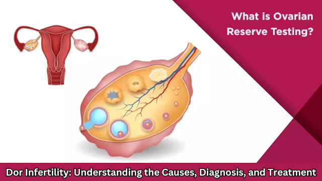 Dor Infertility