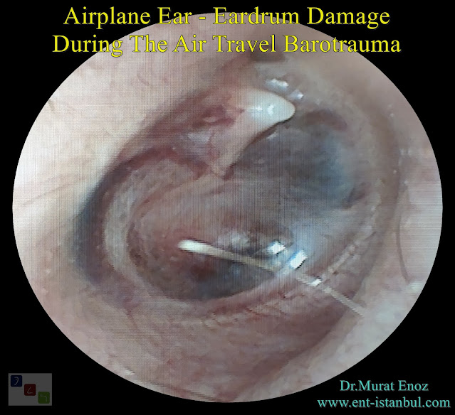 Barotraumatic eardrum damage, Otalgia, Ear pain,Earache,Airplane Ear