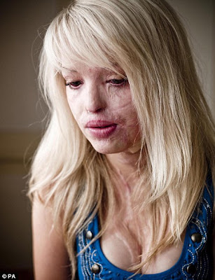 Katie Piper Before And After. welcome folks, this time my hands want to 
