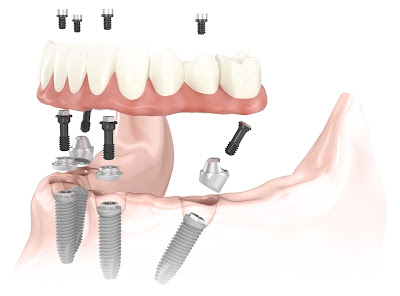 Cấy ghép implant ở đâu tốt nhất ?