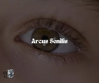 Arcus Senilis