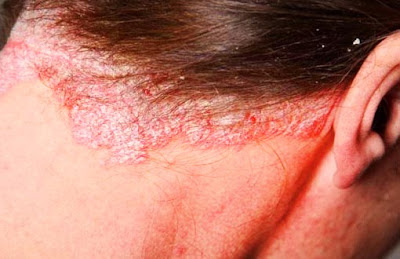 Cause of Psoriasis What causes psoriasis