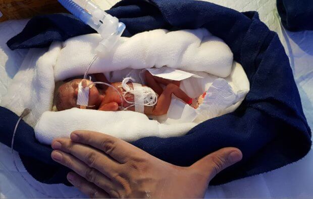 0.8 lb (362.9g) 12-week Premature Baby Is The Smallest To Ever Make It