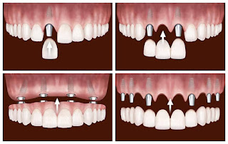 Răng implant có tốt không-1