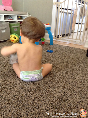 Baby with right torticollis really tilting her head.