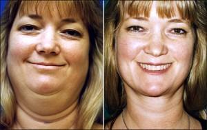 Lose A Double Chin And Face Fat : Planning For Achievable Fat Loss Goals